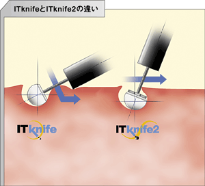 従来機種「ITKnife」と「ITKnife2」の操作性比較