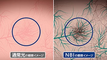 オリンパスが開発したNBI技術を搭載した内視鏡と通常の内視鏡で観察した血管の比較イメージ