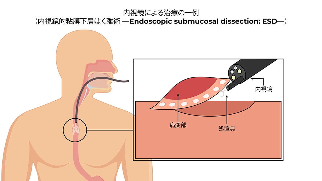 内視鏡による治療の一部（内視鏡的粘膜下層はく離術－Endoscopic submucosal dissection:ESD－）