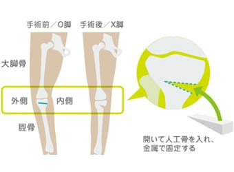 高位脛骨骨切り術のイメージ図