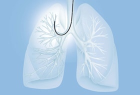 図 内視鏡を気管支へ挿入している様子 ※上葉（肺の上部）へのアプローチ