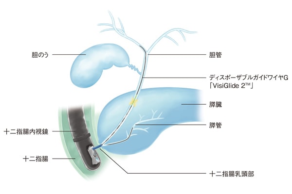 図1 内視鏡を通じてガイドワイヤを胆管や膵管へ挿入している様子（イメージ）