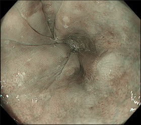 食道のNBI画像（非拡大）