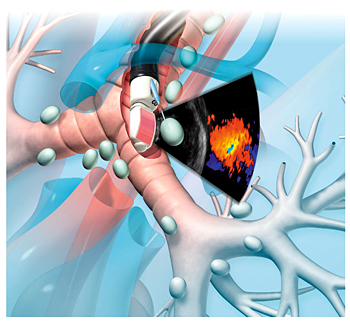 EBUS-TBNA手技のイメージ