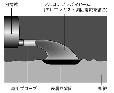 アルゴンプラズマ凝固の模式図