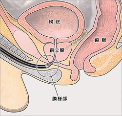 挿入状態イラスト図