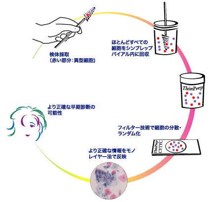 「ThinpPrep」Pap　Testの流れ　イメージ