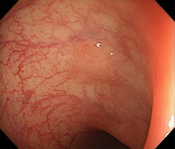 通常光による大腸腺腫の観察像例
