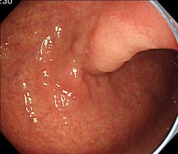 通常光による早期胃癌の観察像例