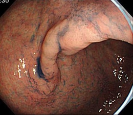 色素散布をした早期胃癌の通常光による観察像例