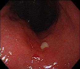 通常光による早期胃癌の観察像例
