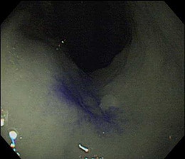 色素散布をした早期胃癌の通常光による観察像例
