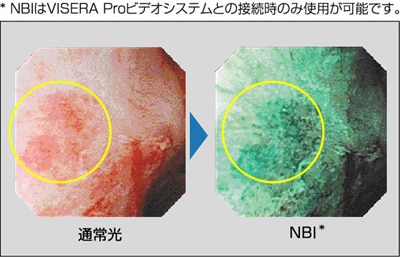 「腎盂上皮内癌の観察画像」