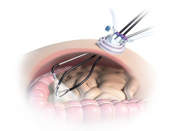 「単孔式腹腔鏡下外科手術」のイメージ