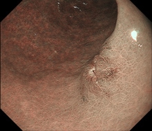 従来製品から向上したNBI画像