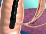 胆管は十二指腸からV字に曲がった位置にある