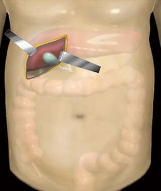 開腹手術のイメージ画像：傷跡が大きくなり患者さんへの身体的負担が大きい