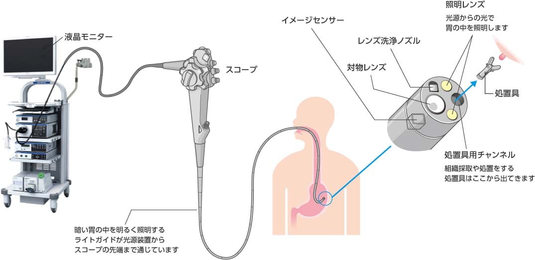 消化器内視鏡システムの例：暗い胃の中を明るく照らすライトガイドが光源装置からスコープの先端まで通じています。スコープの先端には、光源からの光で胃の中を照らす照明レンズ、対物レンズ、対物レンズを洗浄するノズル、組織採取や処置を行う道具を通すためのチャンネルがあります。