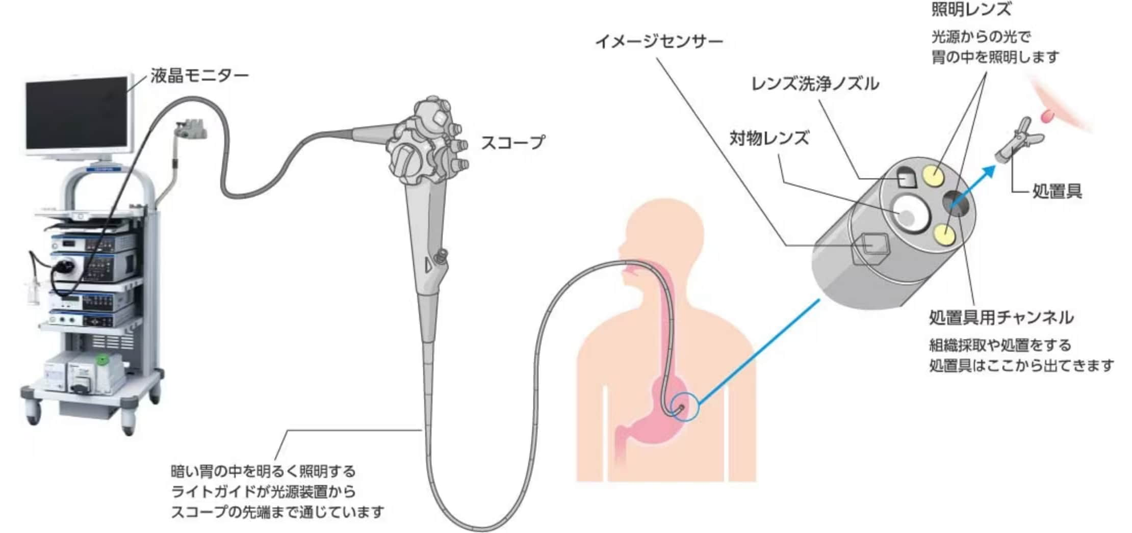 消化器内視鏡システムの例：暗い胃の中を明るく照らすライトガイドが光源装置からスコープの先端まで通じています。スコープの先端には、光源からの光で胃の中を照らす照明レンズ、対物レンズ、対物レンズを洗浄するノズル、組織採取や処置を行う道具を通すためのチャンネルがあります。