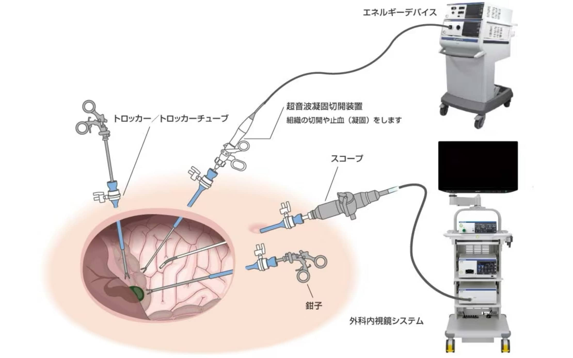 腹腔鏡手術の例：トロッカー／トロッカーチューブ、組織の切開や止血（凝固）をする超音波凝固切開装置、スコープ、鉗子を使用します