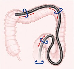 内視鏡ビデオスコープシステム Evis Lucera Elite 患者さまにはよりやさしく 先生にはより扱いやすく 製品技術 オリンパス